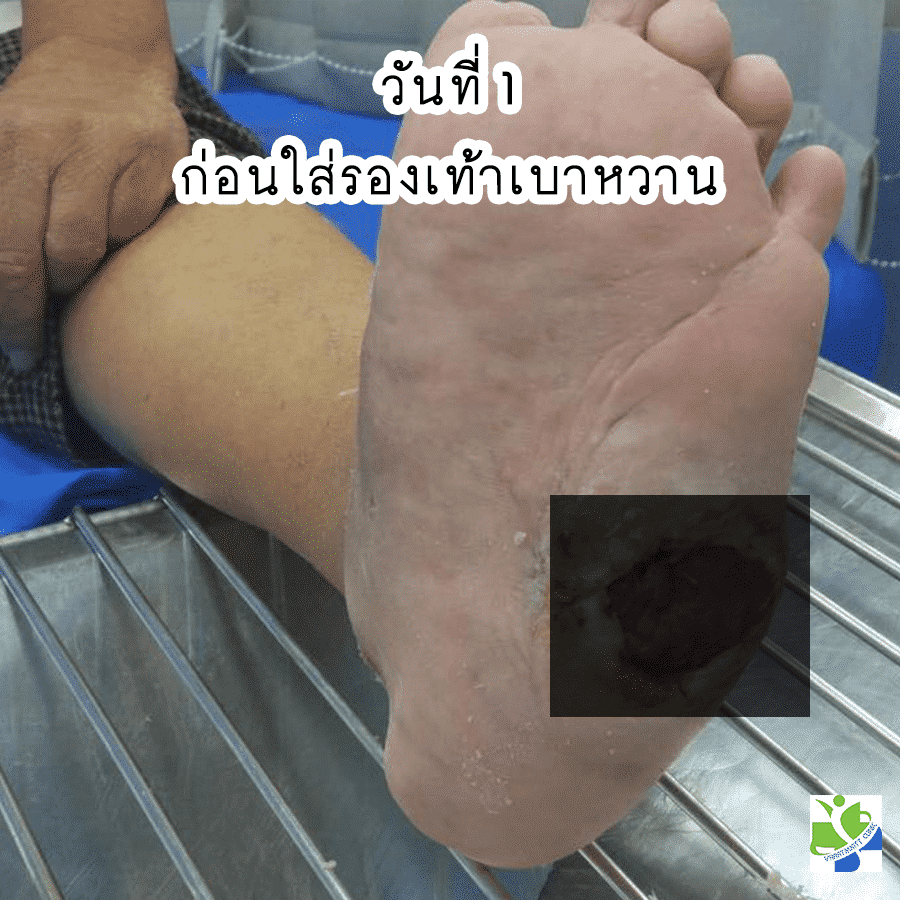 ใส่รองเท้าเบาหวานวันที่ 1