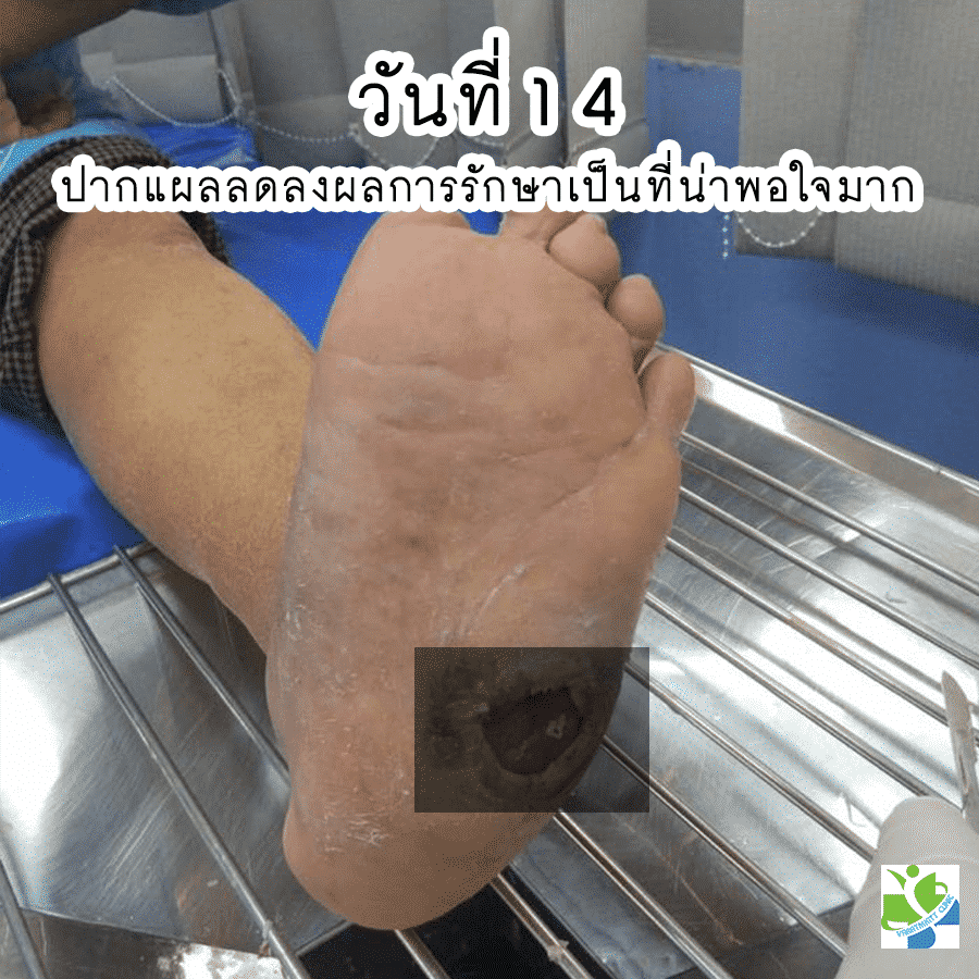 ใส่รองเท้าเบาหวานวันที่ 21