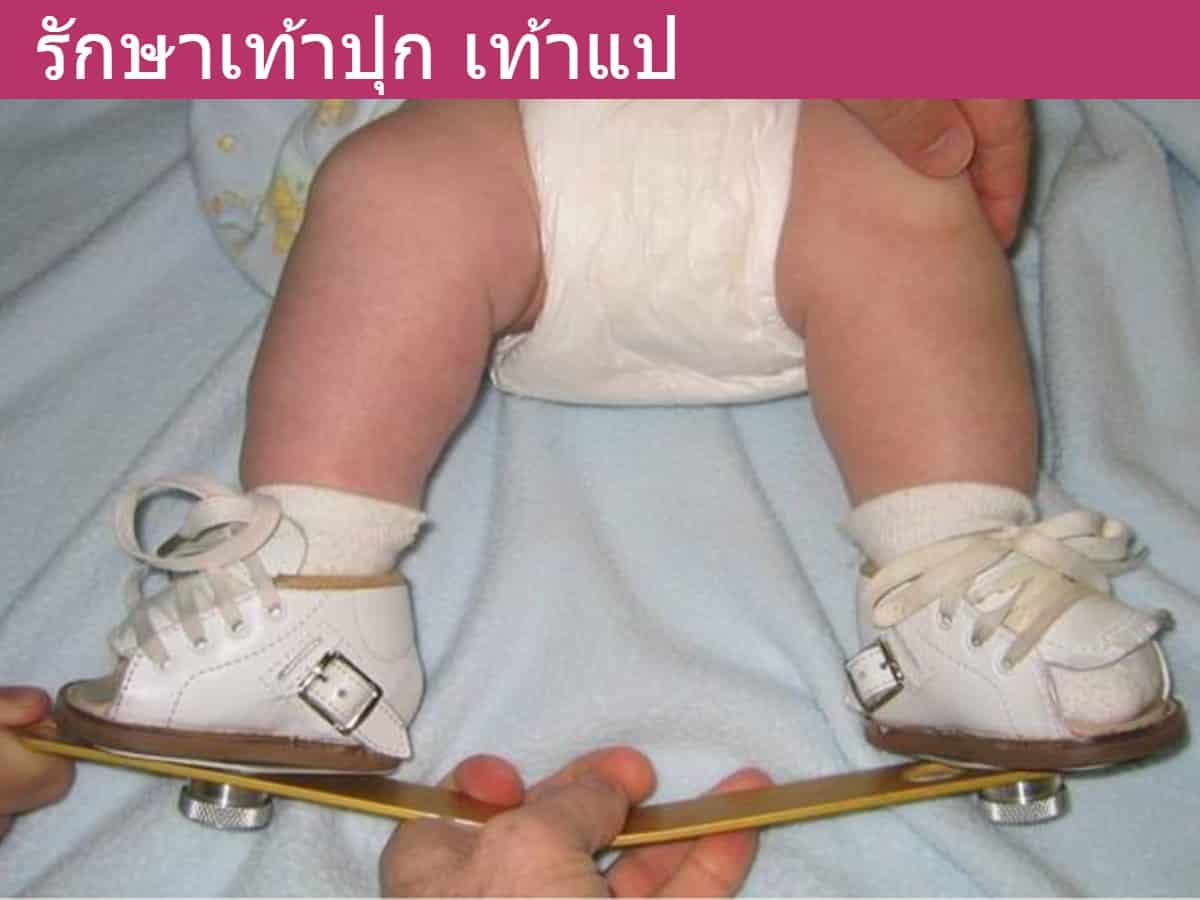 รักษาเท้าปุก เท้าแป