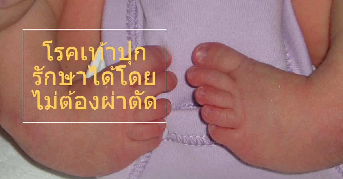 โรคเท้าปุก (Clubfoot) รักษาได้โดยไม่ต้องผ่าตัด