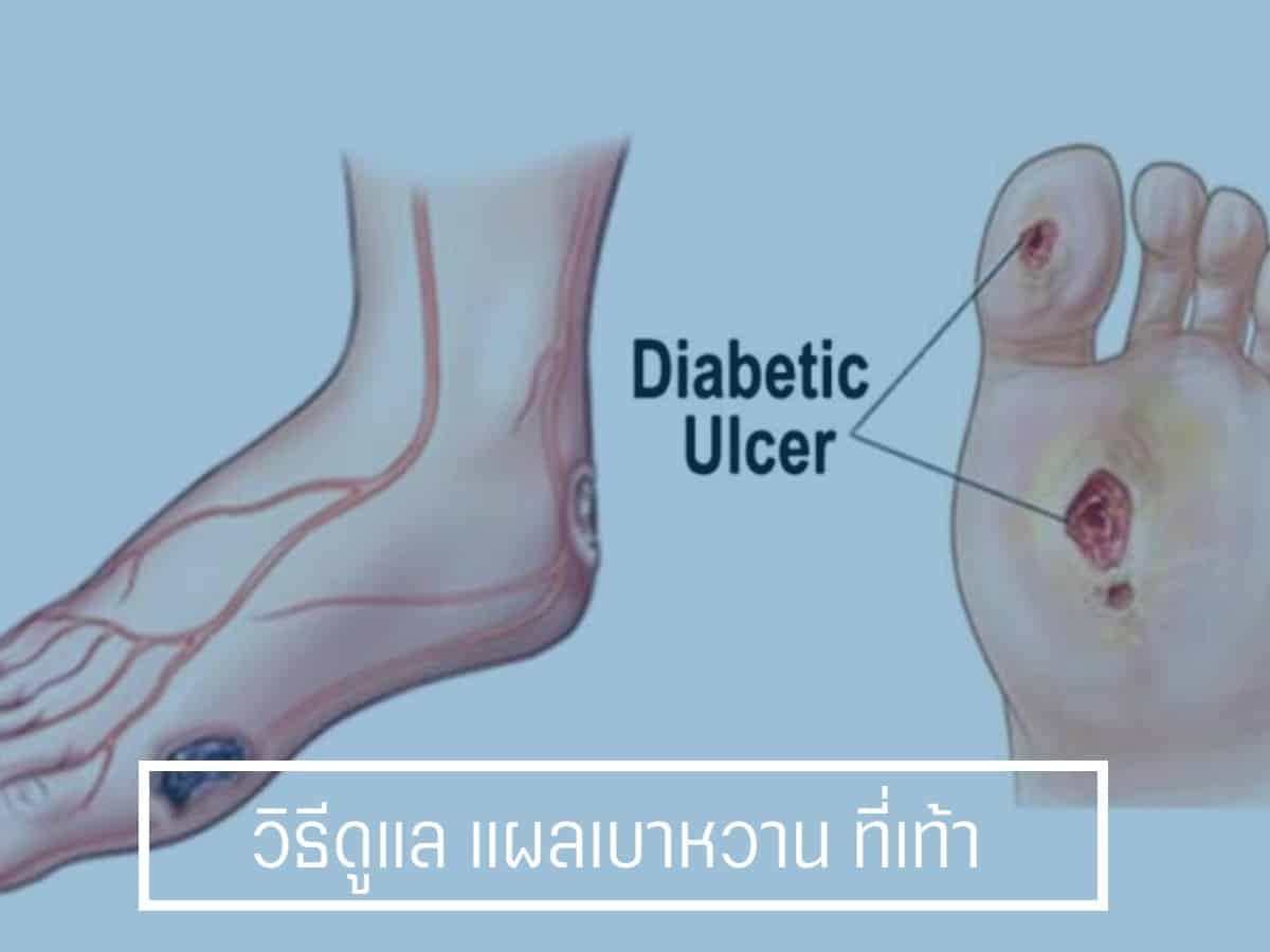 แผลเบาหวาน