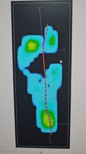 นวัตกรรมในการรักษาเท้าแบน