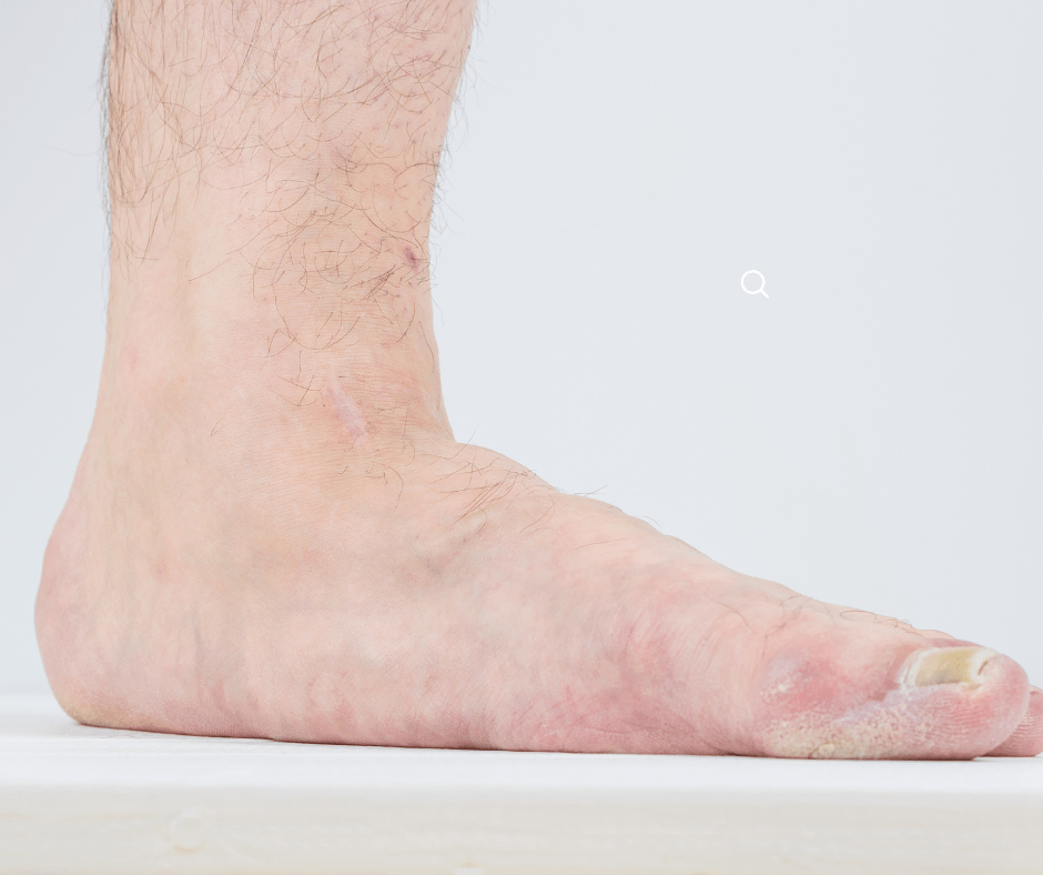 เท้าแบนคืออะไร